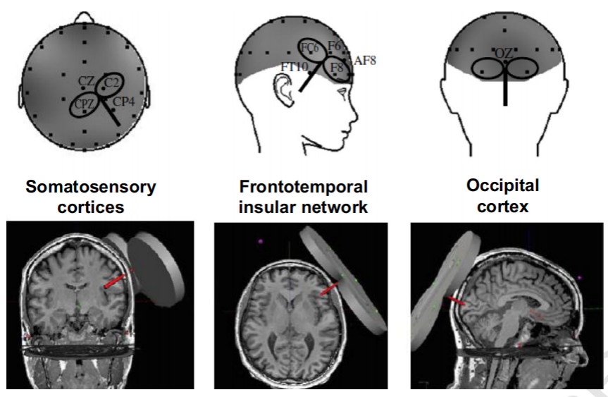 MRI,腦電,TMS